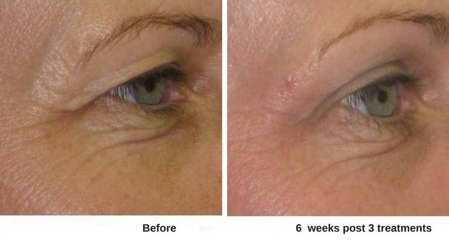 Womans face before and after skin resurfacing at Forever Young Medspa.