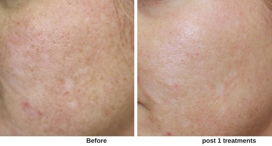 Womans face before and after skin resurfacing at Forever Young Medspa.