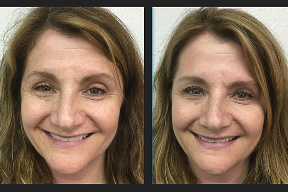 plasma facial before and after
