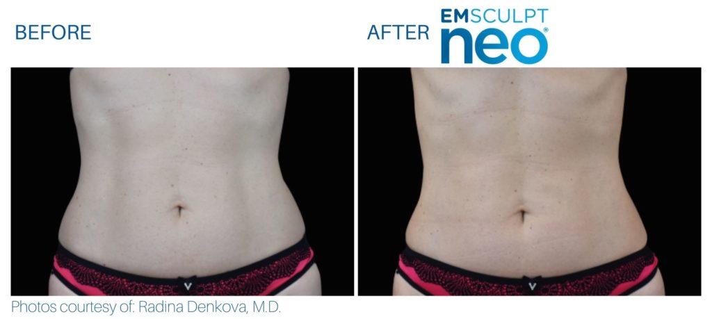 Emsculpt Neo | Belly Before and After | Best Medspa in Lincolnwood photo