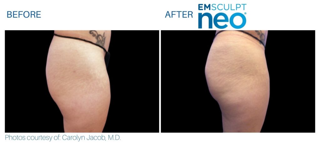 Emsculpt Neo | Buttocks Before and After | Best Medspa in Lincolnwood photo