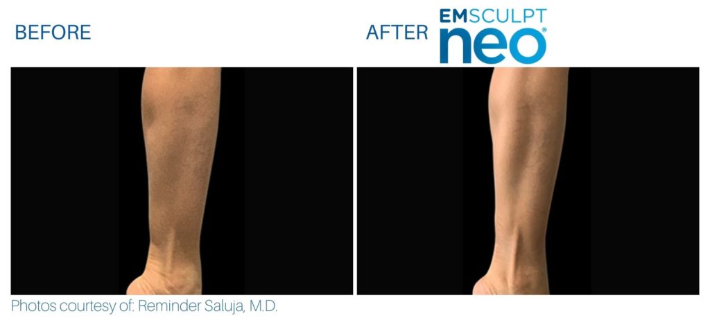 Emsculpt Neo area | Arm Before and After | Best Medspa in Lincolnwood photo