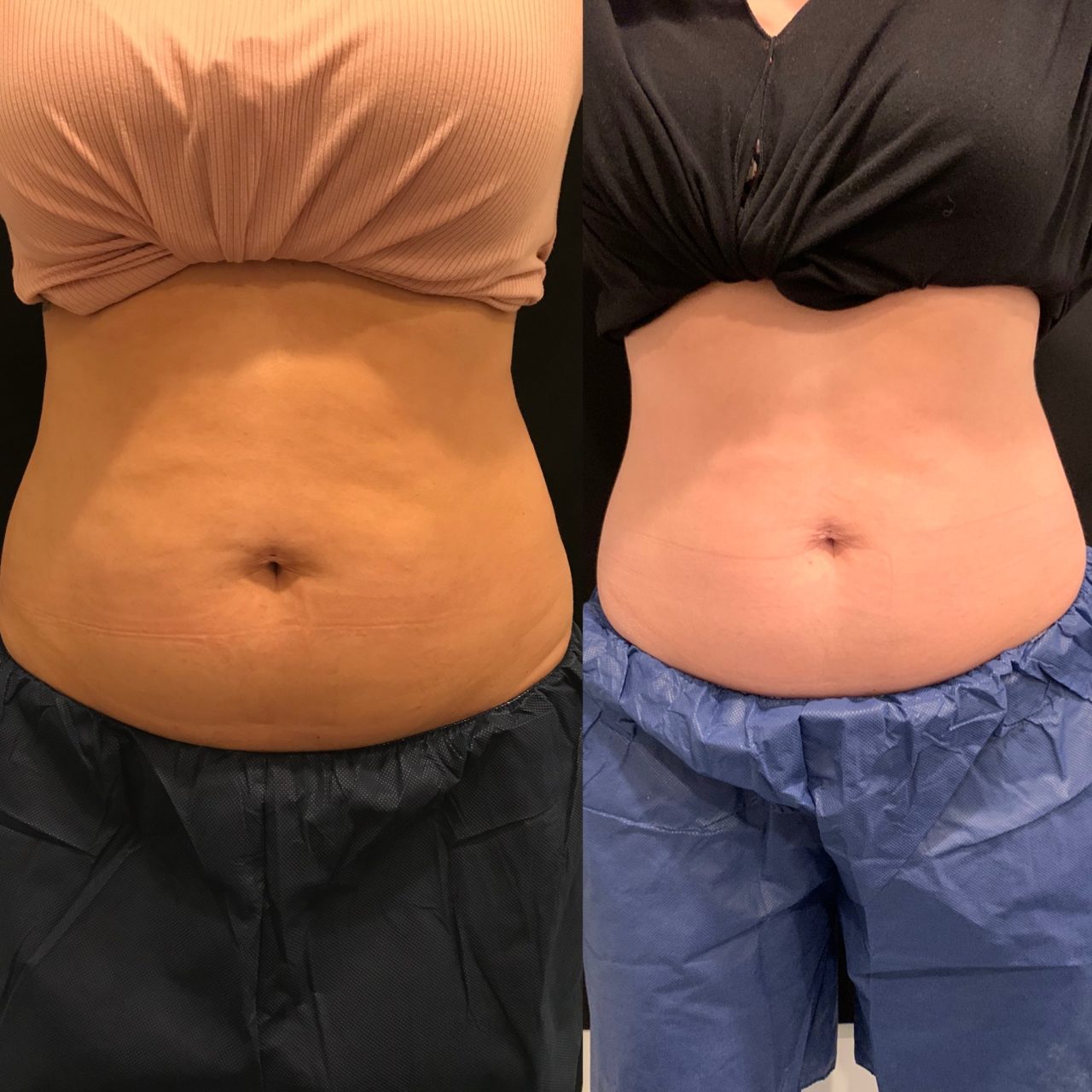 CoolSculpting Elite, 50% Off Packages
