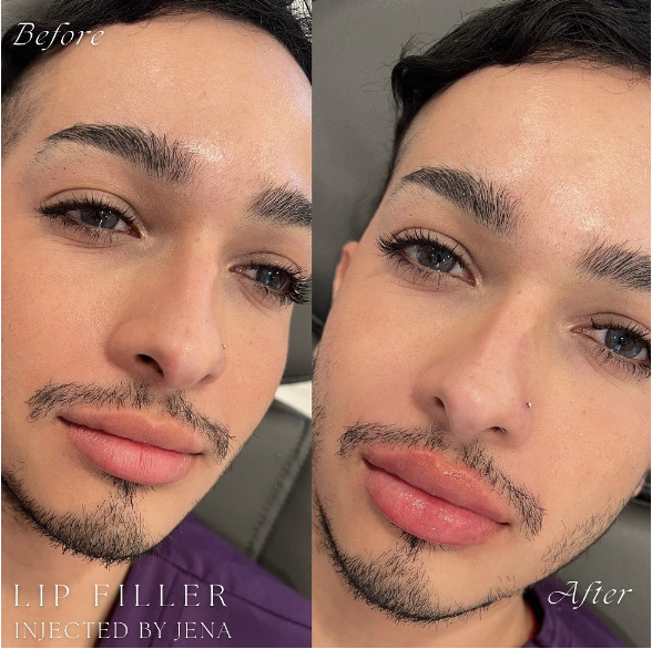 Lip Filler compared to Lip Flip photo